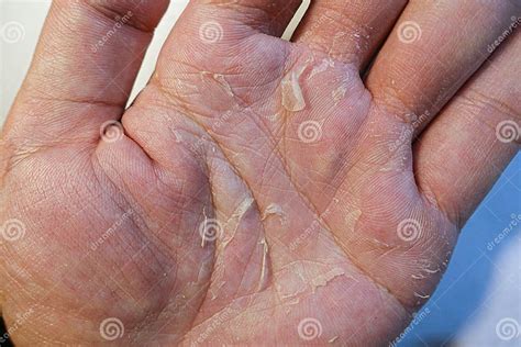 Palm Peeling Eczema Skin Disease Stock Image Image Of Disease Palm