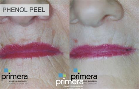 Chemical Peel Before And After Pictures Case 103 Orlando Florida