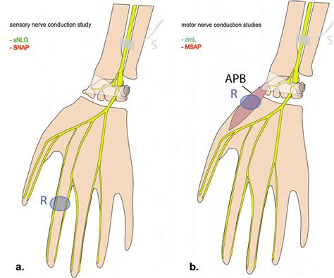 Schematic Drawing Of Median Nerve Conduction Measurements Sensory