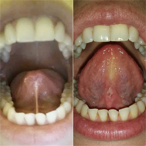 Under Tongue Pain Medication Mapasgmaes