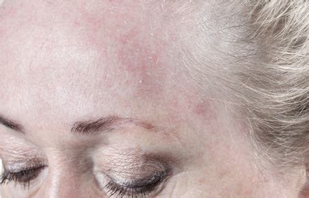 Dehydrated skin lacks water and appears dull or rough. Woman´s scaly forehead