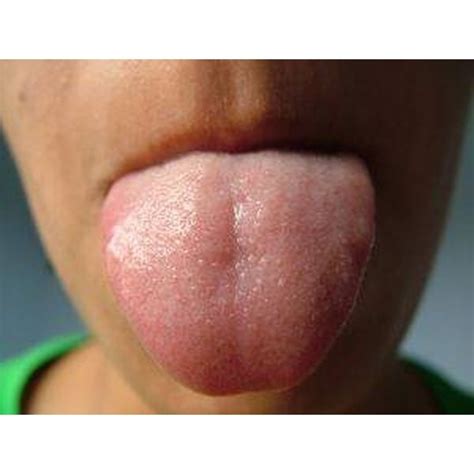 A persistent sore throat if you're not sick but just can't seem to kick that scratchy sore throat, it could be one of the early signs of throat cancer. Types of Tongue Cancer | Healthfully