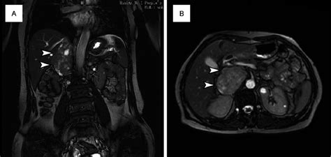 The Mri Features Of The Ivc Tumor With Mixed T1wi And T2wi Signals The