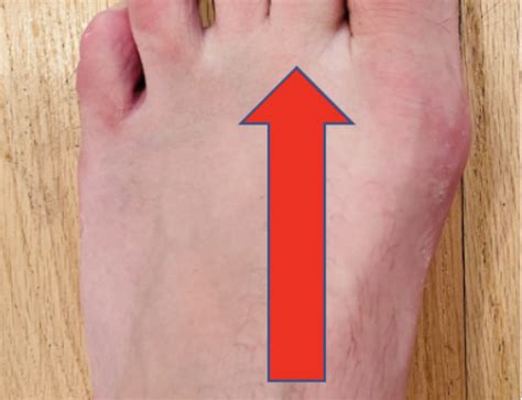 Adductor Hallucis Weakness Causes Painful Toes Arch And Creates