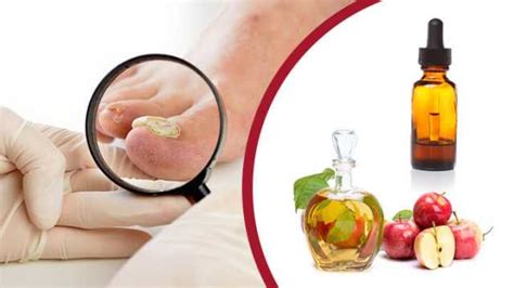 7 Truly Amazing Natural Remedies For Toenail Fungus