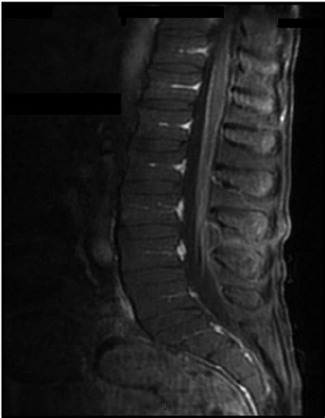 Lumbar Spine T1 Weighted Mri Sequence Showing Contrast Enhancement Of