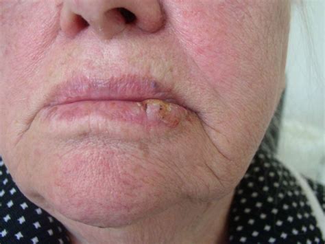 Cold Sore Or Cancer On Lip Cancerwalls