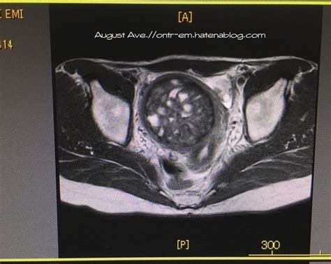 UEA治療前の子宮筋腫9cmのMRI画像を紹介 - August Ave．