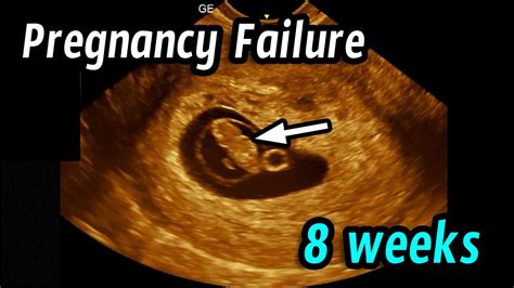 How Does A Miscarriage Look At 6 To 8 Weeks
