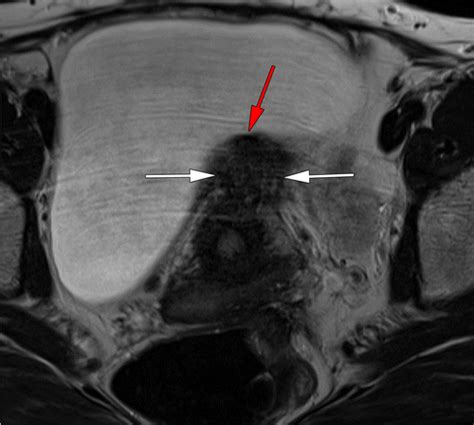 Suspensory Ligaments Of The Female Genital Organs Mri Evaluation With
