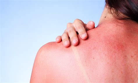 How To Heal Sunburn Tips For Treatment And Prevention Fluxies