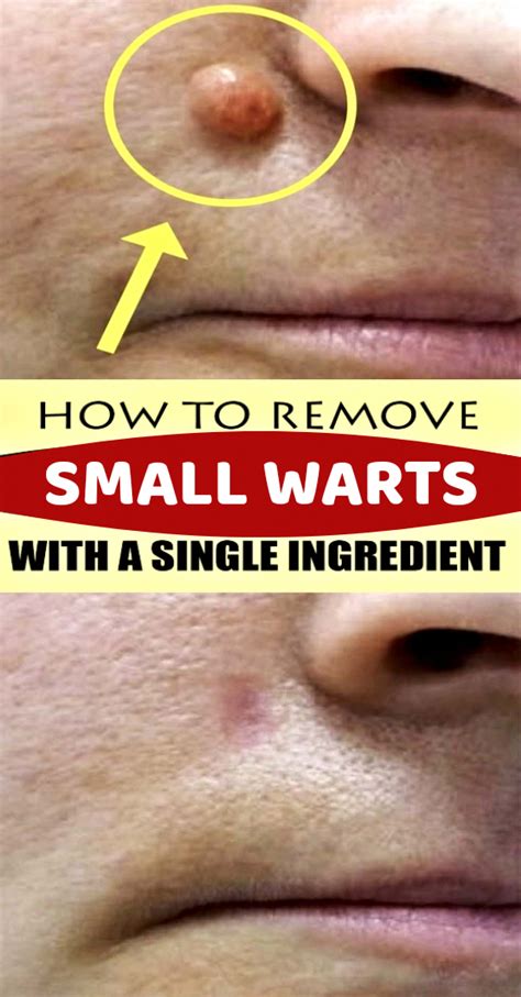 How To Remove Warts On Elbow Howtoremvo