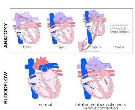 Aliases & classifications for total anomalous pulmonary venous return 1. Congenital Defects Tutorial - Congenital Heart Defects ...