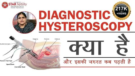 Diagnostic Hysteroscopy In Hindi Before Ivf Diagnostic Test