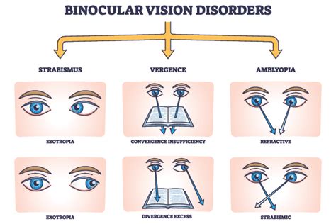 Treating Binocular Vision Dysfunction A Step By Step Guide