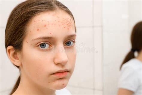 Face Of A Teenage Girl With Pimples She Looks At Herself In The Mirror