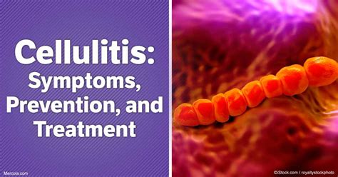 What Is Cellulitis