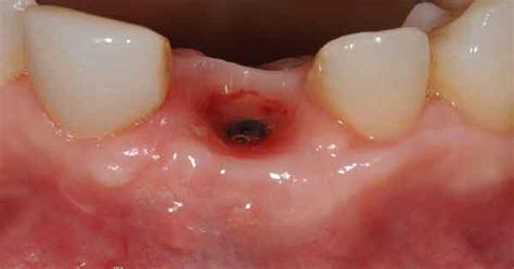 Tipos De Alveolitis Tratamiento Y Prevención Centre Dental Puigandbaldrich