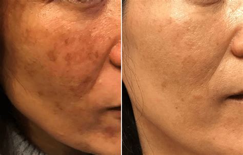 Removing Sun Damage Brown Spots On Asian Mature Skin Before And After