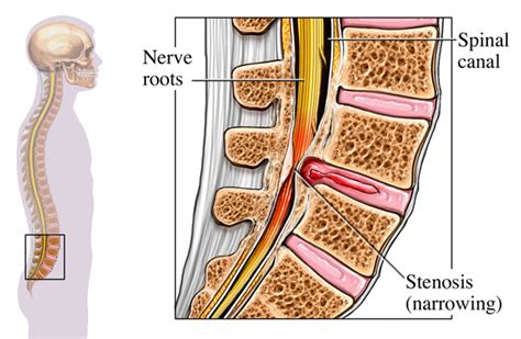 Stem Cell Treatment For Spinal Stenosis Ladegrussian