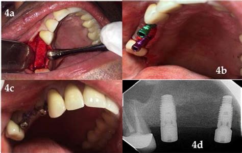 Maxillary Sinus Elevation Using Simple Dental Instruments With