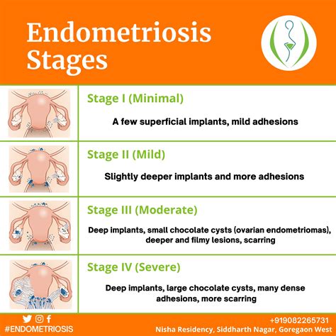 Understanding Endometriosis: Stages and Beyond