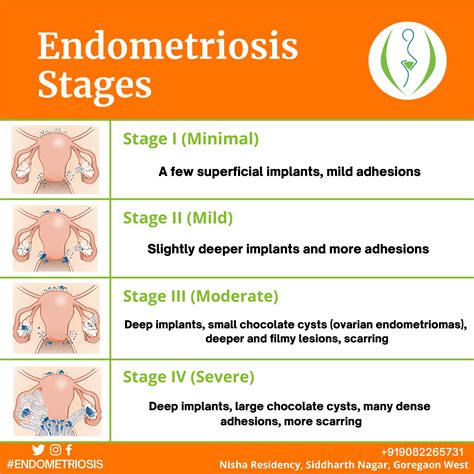 Understanding Endometriosis Stages And Beyond
