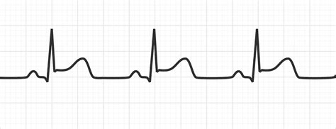 Absence of reciprocal st depression elsewhere. Pericarditis on ECG | ECG Disease Patterns - MedSchool