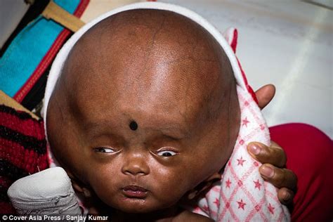 Indian Baby S Head Tripled In Size Due To Hydrocephalus Daily Mail Online