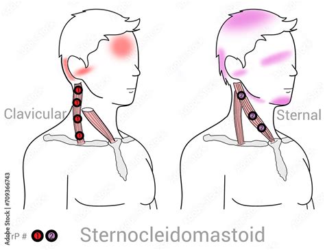 Sternocleidomastoid Myofascial Trigger Points And Associated Pain