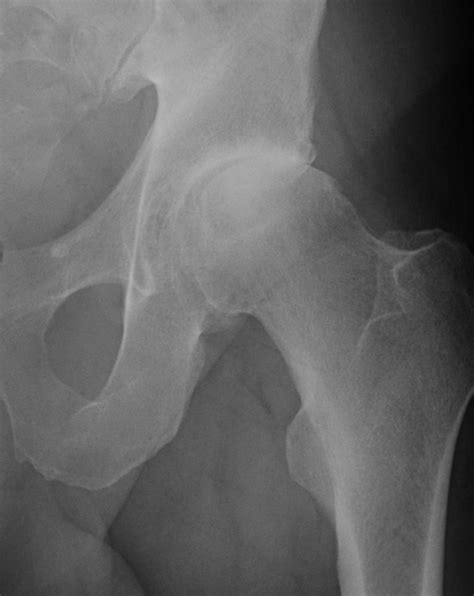 Pistol Grip Deformity Seen On An Anteroposterior X Ray Of The Left Hip