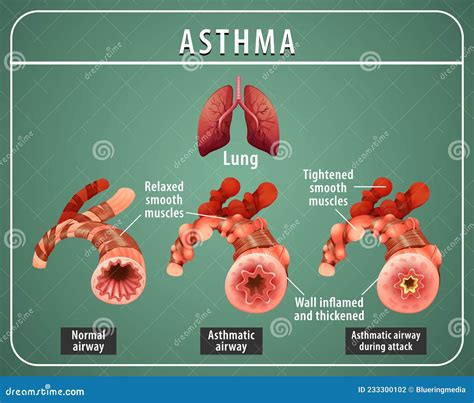 Asthma Diagram With Normal Airway And Asthmatic Airway Vector