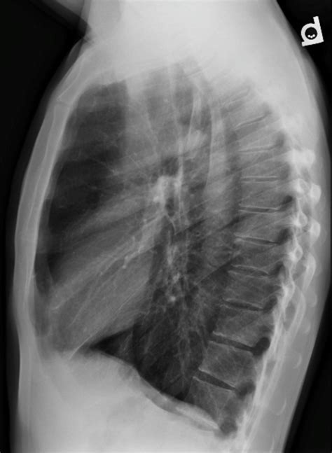 A review of how to diagnose a pneumothorax, various forms of pleural effusion, other forms of pleural disease, and pneumoperitoneum. Emphysema - Undergraduate Diagnostic Imaging Fundamentals