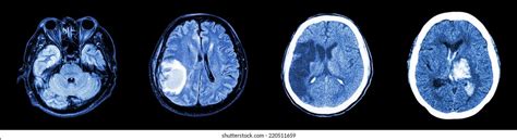Collection Ct Scan Brain Multiple Disease Stock Photo 220511659