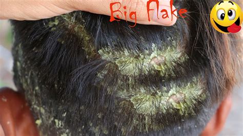 Dry Scalp Psoriasis And Itchy Scalp Removal Step By Step With Lice