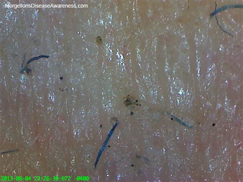 Morgellons Disease Awareness Morgellons Disease Physicians Reference