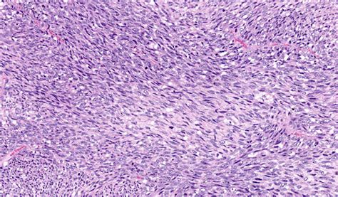 Pathology Outlines Malignant Peripheral Nerve Sheath Tumor Mpnst
