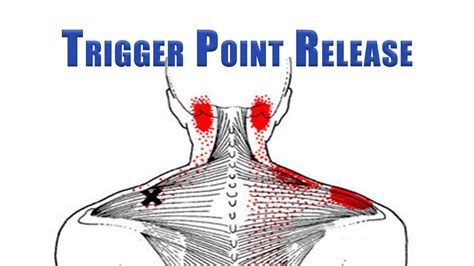 Trigger Point Release Upper Trapezius Levator Scapulae And