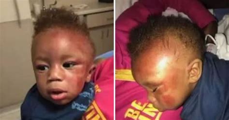 Daycare Left Baby Bruised Bitten And With Hair Pulled Out Metro News