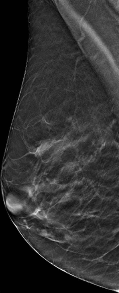Interval And Consecutive Round Breast Cancer After Digital Breast