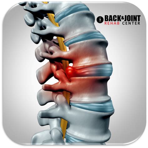 Herniated Disc Disc Herniation Chiropractor Lower Back Pain Therapy