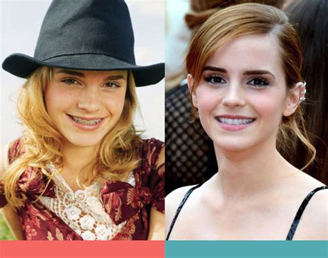 Adult Braces Emma Watson