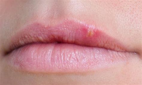 Bump On Lips Not Painful A Cold Sore White Red Tiny Remedies