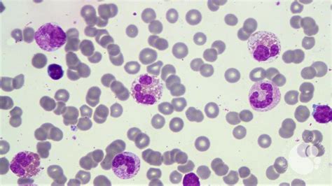 Chronic Eosinophilic Leukemia With Fip1l1 Pdgfra