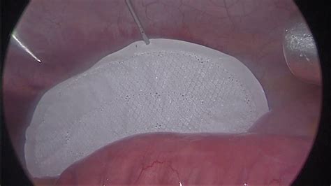Laparoscopic Supraumbilical Hernioplasty Youtube
