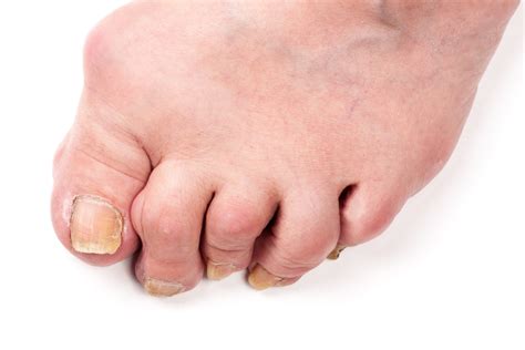 What Causes Hammertoe Types Diagnosis Treatment 53 Off