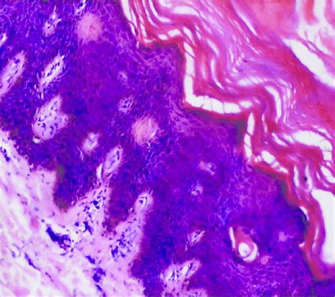 Moderate Acanthosis Hyperkeratosis Focal Parakeratosis And Mild