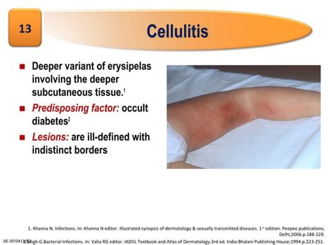 Superficial Bacterial Infection Ppt