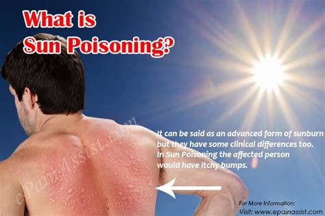 5 Ways To Treat Sun Poisoning Tsmp Medical Blog