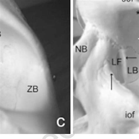 11 Lateral Orbitotomy Procedure A Anchoring The Lateral Rectus